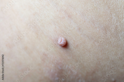 Skin tag or acrochordon or soft fibroma or mole. macro photo. Papilloma virus or bump, dermatology problem on skin concept. photo