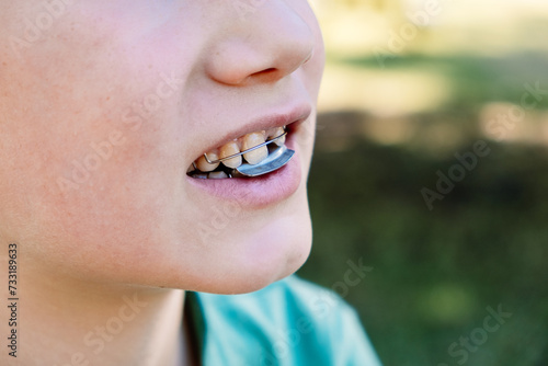 Child with orthodontic appliance to correct malocclusion, forward bite photo