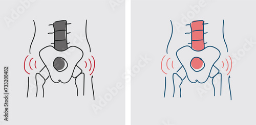 During hip replacement surgery, the orthopedic surgeon makes an incision over the hip joint, removes the damaged or diseased portions of the hip joint, and prepares the bone surfaces to receive the pr
