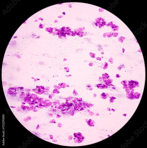 Pap's smear. Microscopic examination of pap smear showing inflammatory smear with reactive cellular changes. NILM. cervical cancer diagnosis. photo