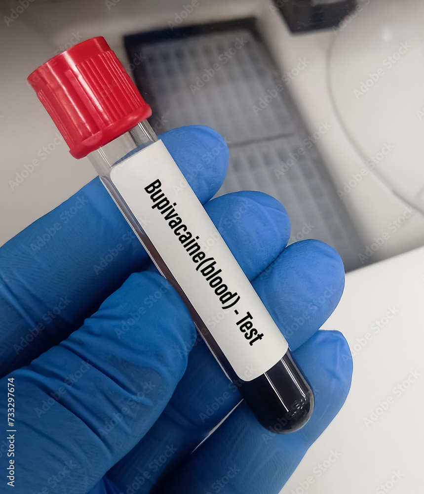 Blood sample for Bupivacaine or Marcaine blood test, It indicated for