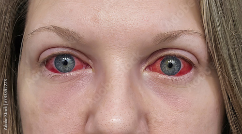 Conjunctivitis - Pink Eyes, Covid-19 Eyes, close-up
