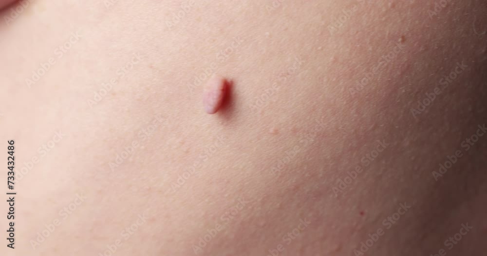 Close-up of Neoplasm or Birthmark on the Skin of an adult male. Pigmented spots on the back of a man. Skin with moles and Acne. Close-up of Neoplasm or Birthmark on the Skin of an adult male. Pigmented spots on the back of a man. Skin with moles and Acne.