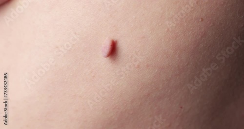 Close-up of Neoplasm or Birthmark on the Skin of an adult male. Pigmented spots on the back of a man. Skin with moles and Acne.