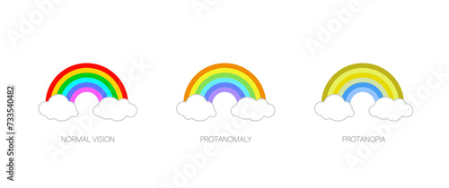 Protanomaly and protanopia