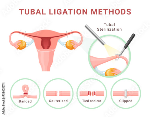 Tubal ligation methods female sterilization medical infographic scheme design template vector