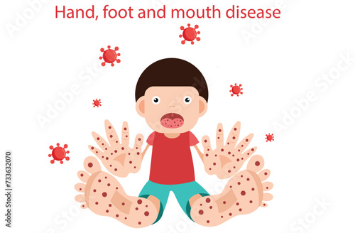 Hand, foot and mouth disease,mouth ulcers and spots on the hands and feet,young children,(HFMD) with symptoms, Children infected vector illustration, Kid is sick when rainy season,girl