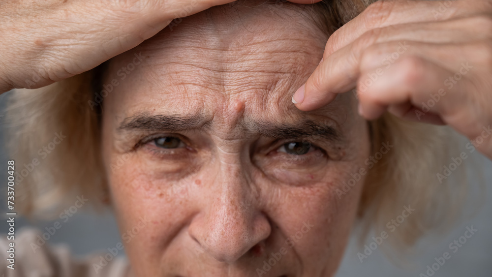 Obraz premium Unhappy elderly woman pointing at wrinkles on her forehead. 