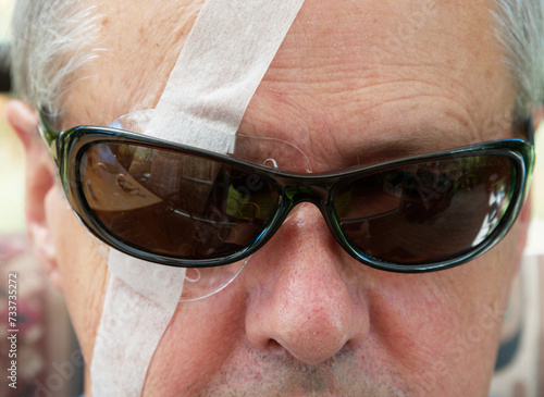 A transparent eye shield is taped over a man's eye to protect it while it heals from IOL surgery.
