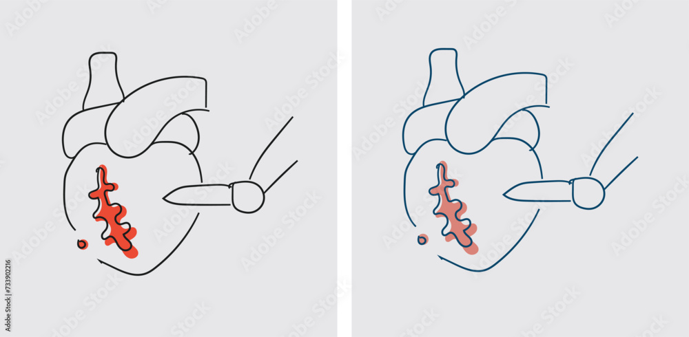 Vector Cabg CABG is effective in relieving symptoms of coronary artery disease (CAD ...