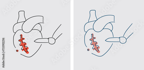 CABG is effective in relieving symptoms of coronary artery disease (CAD), such as chest pain (angina), by restoring proper blood flow to the heart muscle