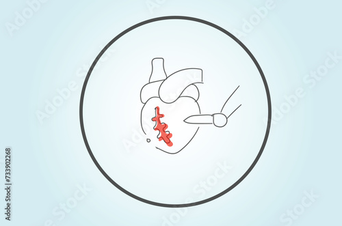 Coronary Artery Bypass Grafting (CABG) is a surgical procedure used to treat coronary artery disease (CAD)