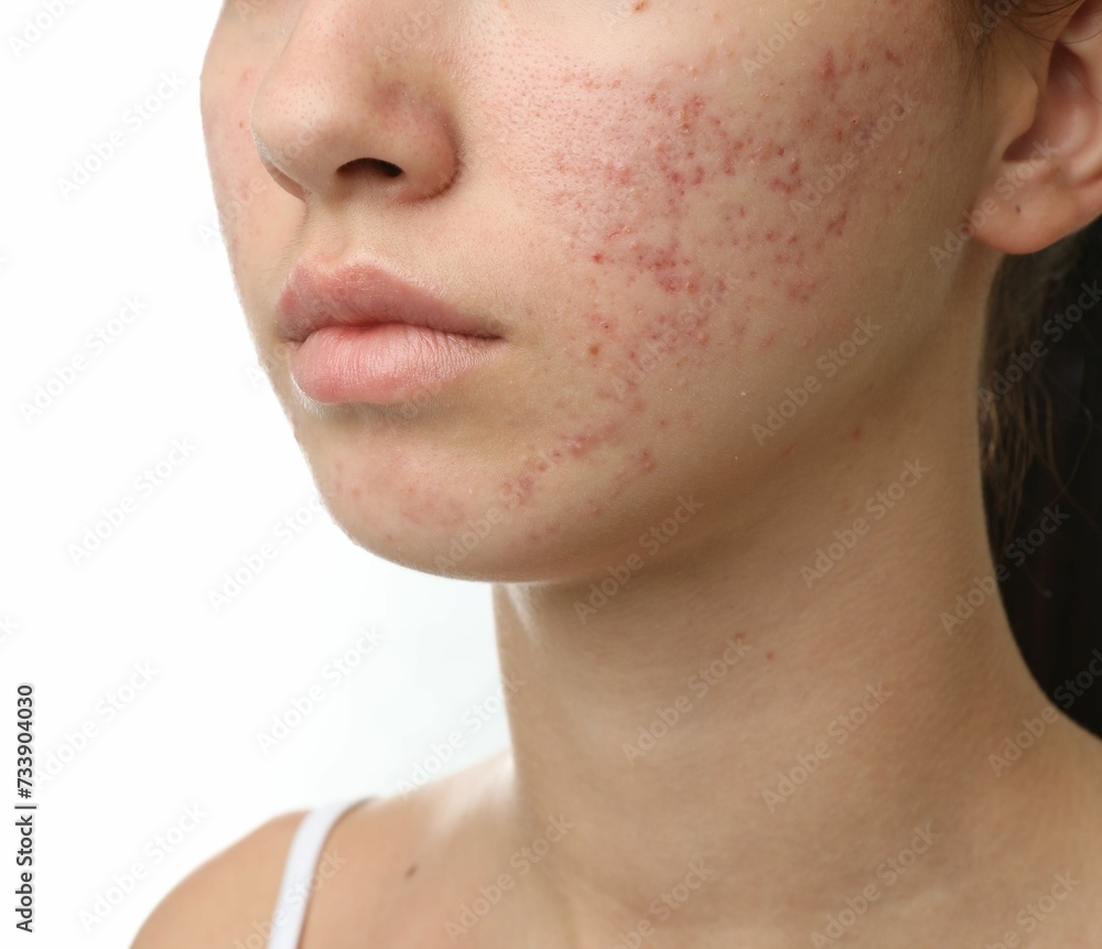 Obraz premium Teenage girl with acne problem on white background, closeup