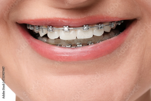 Smiling woman with dental braces, closeup view