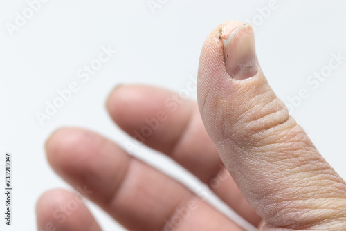 cut on thumb tip of a woman hand