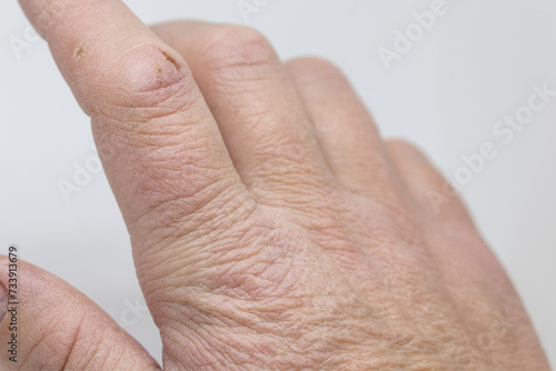 cracked skin on index finger of a woman hand