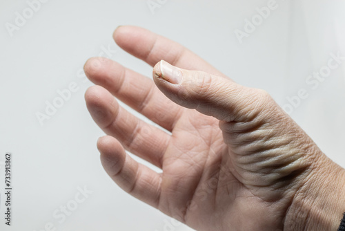 woman hand with cracked skin on thumb