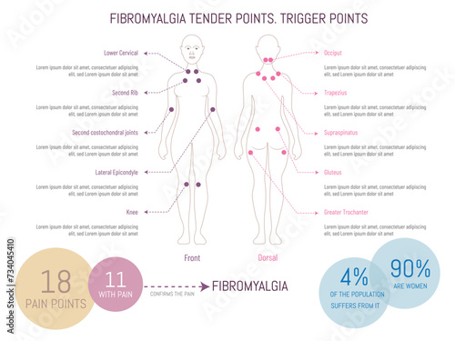 Infographic of the most sensitive points of fibromyalgia, trigger points where you have more pain, marked with a dot in a silhouette of a human body on a white background.