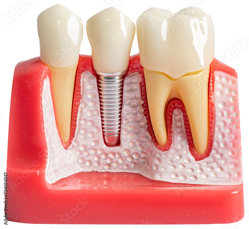 Dental implant, artificial tooth roots into jaw, root canal of dental treatment, gum disease on white background, teeth model for dentist studying about dentistry.