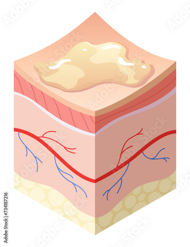 Skincare medical concept. Problems in cross-section of human skin horizontal layers structure. Anatomy illustrative model unhealthy layer of skin