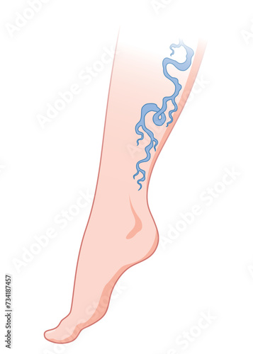 Varicose veins. Blue blood vessel visible through the skin, abnormally swollen leg. Vascular disease diagnostic and treatment. Venous insufficiency medical disease