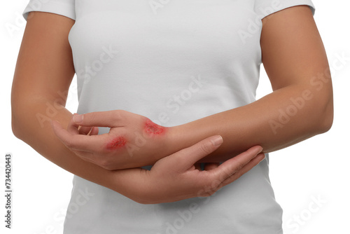 Wallpaper Mural Woman with burned hand on white background, closeup Torontodigital.ca