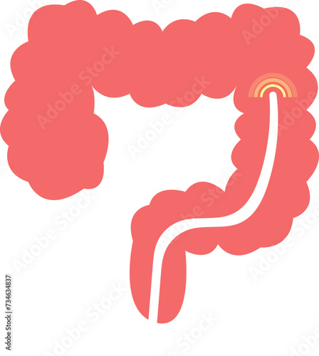 colon cancer. colonoscope in the colon. polyp removal. 2d illustration. 대장용종, 담낭석, 담석, 담낭염, 담석증, 대장내시경, 위내시경, 아이콘, 일러스트 벡터