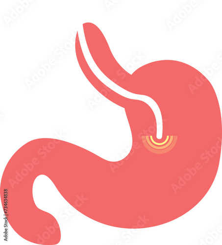 colon cancer. colonoscope in the colon. polyp removal. 2d illustration. 대장용종, 담낭석, 담석, 담낭염, 담석증, 대장내시경, 위내시경, 아이콘, 일러스트 벡터