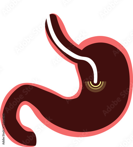 colon cancer. colonoscope in the colon. polyp removal. 2d illustration. 대장용종, 담낭석, 담석, 담낭염, 담석증, 대장내시경, 위내시경, 아이콘, 일러스트 벡터