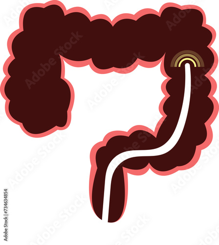 colon cancer. colonoscope in the colon. polyp removal. 2d illustration. 대장용종, 담낭석, 담석, 담낭염, 담석증, 대장내시경, 위내시경, 아이콘, 일러스트 벡터