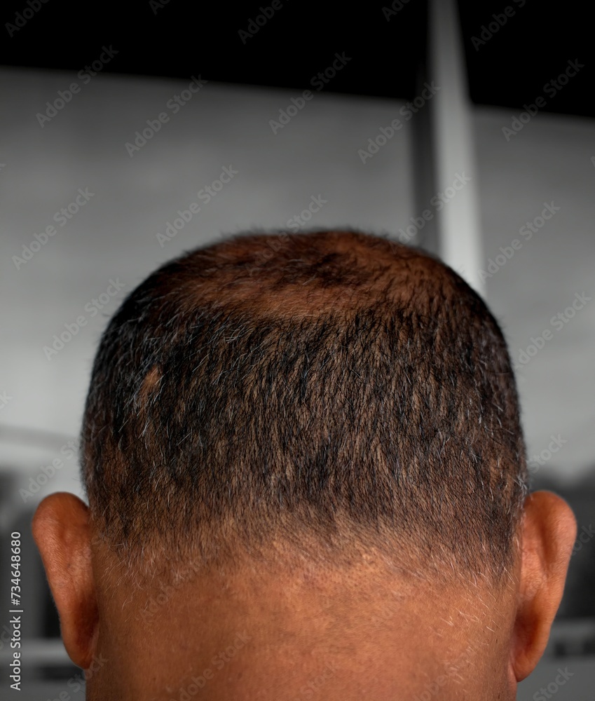 man's head seen from behind, starting to lose hair, Man with hair problems man's head seen from behind, starting to lose hair, Man with hair problems
