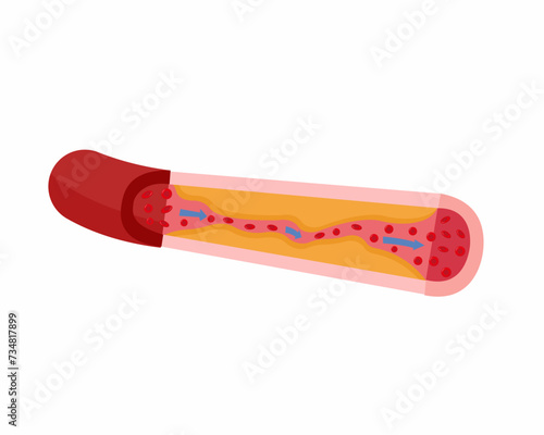Cholesterol in artery health risk Atherosclerosis risk Healthcare Vector illustration.