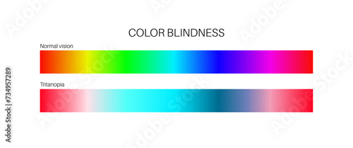 Tritanopia and tritanomaly