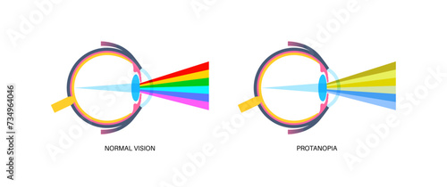 Protanomaly and protanopia