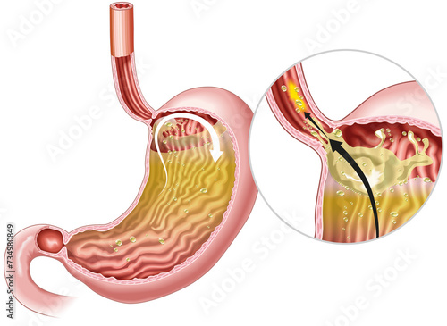 Gastrophageal reflux disease (GERD). Illustration