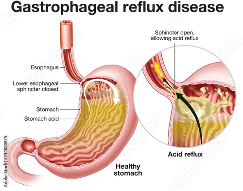 Gastrophageal reflux disease (GERD). Illustration. Labeled photo