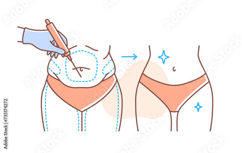 Plastic surgery body doodle. Woman in red swimsuit with liposuction. Skincare and beauty treatment, spa procedures. Poster or banner. Linear flat vector illustration isolated on white background