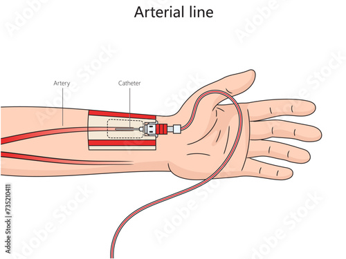 Arterial line structure thin catheter inserted into an artery diagram hand drawn schematic vector illustration. Medical science educational illustration