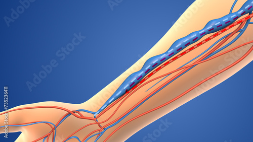 Vászonkép Medical animation of the Arteriovenous fistula
