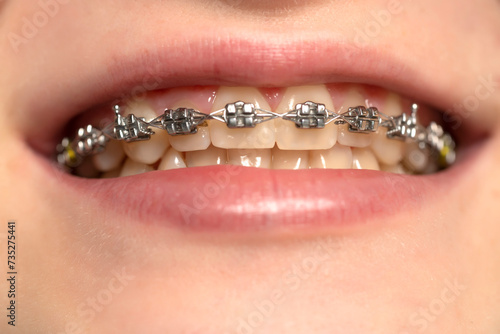 Beautiful macro shot of natural white teeth with braces. Dental care photo. Beauty woman smile with ortodontic accessories.
