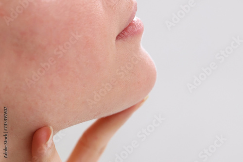 Rosacea and Food allergy concept. Young woman with sensitive skin irritation close up. Soft focus image