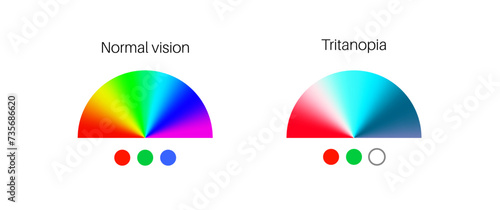 Tritanopia and tritanomaly