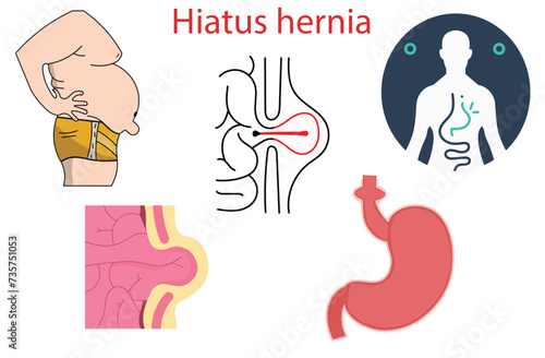 hiatus hernia,hiatal hernia,part of the stomach squeezes up into the chest through an opening in the diaphragm,Stomach,illustration for biological, science, and medical use,overweight,five vectors