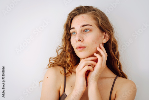 Cuadro en lienzo Young woman with problem skin