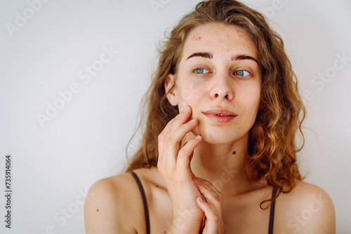 Fotografía Young woman with problem skin
