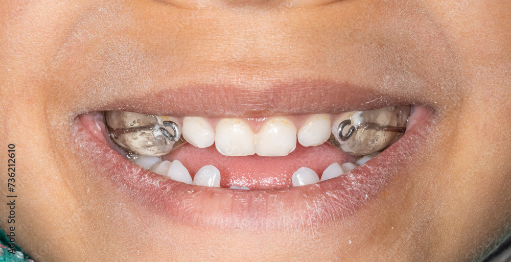 Frontal view of a young dental patient case smiling. Palatal expander