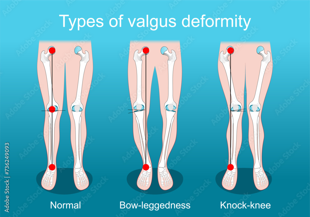 valgus deformities. Knee deformity. Corrective surgery - obrazy, fototapety, plakaty 