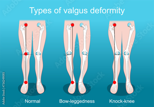 valgus deformities. Knee deformity. Corrective surgery