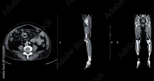 A CT venogram of the leg is a non-invasive imaging procedure offering detailed visuals of leg veins. photo