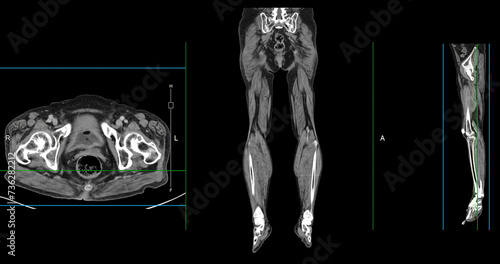 A CT venogram of the leg is a non-invasive imaging procedure offering detailed visuals of leg veins. photo